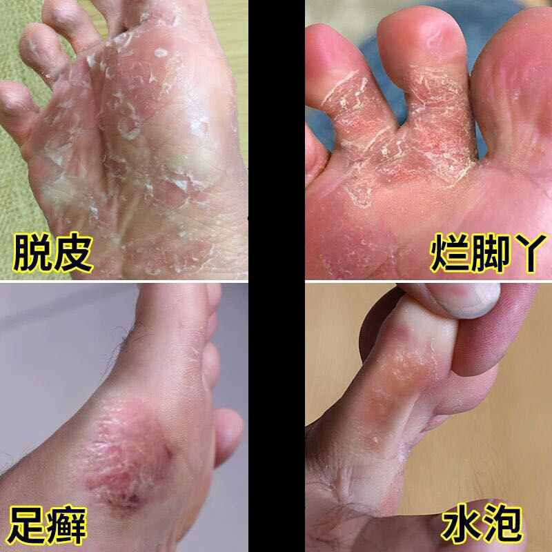 脚部健康守护，解析脚痒、脱皮、起水泡及烂脚丫的成因与最佳用药指南